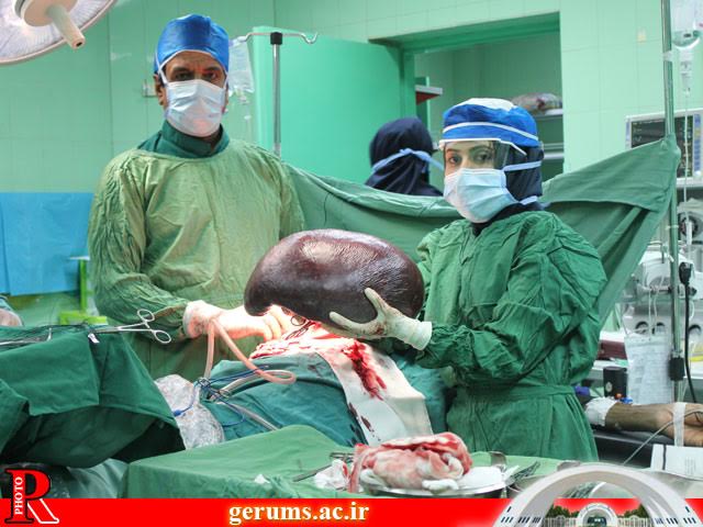 خروج تومور 9کیلویی از شکم بیمار در گراش