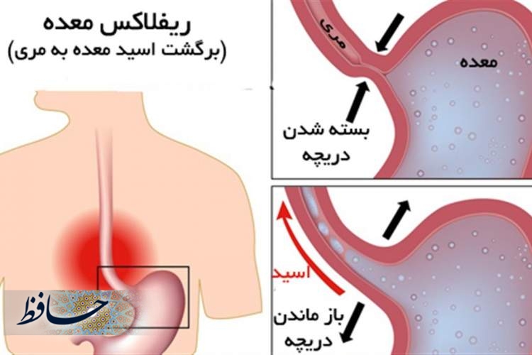 کنترل علائم ریفلاکس معده‌ای-مری در نوروز