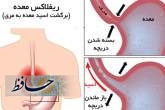 کنترل علائم ریفلاکس معده‌ای-مری در نوروز