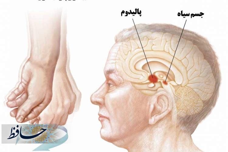 بزرگداشت روز جهانی پارکینسون در شیراز