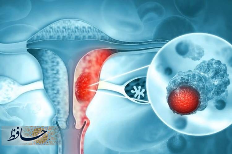 اهمیت تشخیص به موقع در درمان سرطان دهانه رحم